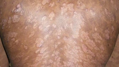 guttate psoriasis appear on back of olive typed skin tone. Appears as small, drop-shaped lesions on the trunk, arms, legs, and scalp.