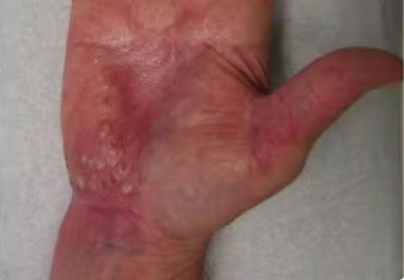 pustular psoriasis, shown on right hand and right wrist. pustular psoriasis is Characterised by white pustules (blisters of non-infectious pus) surrounded by red skin.