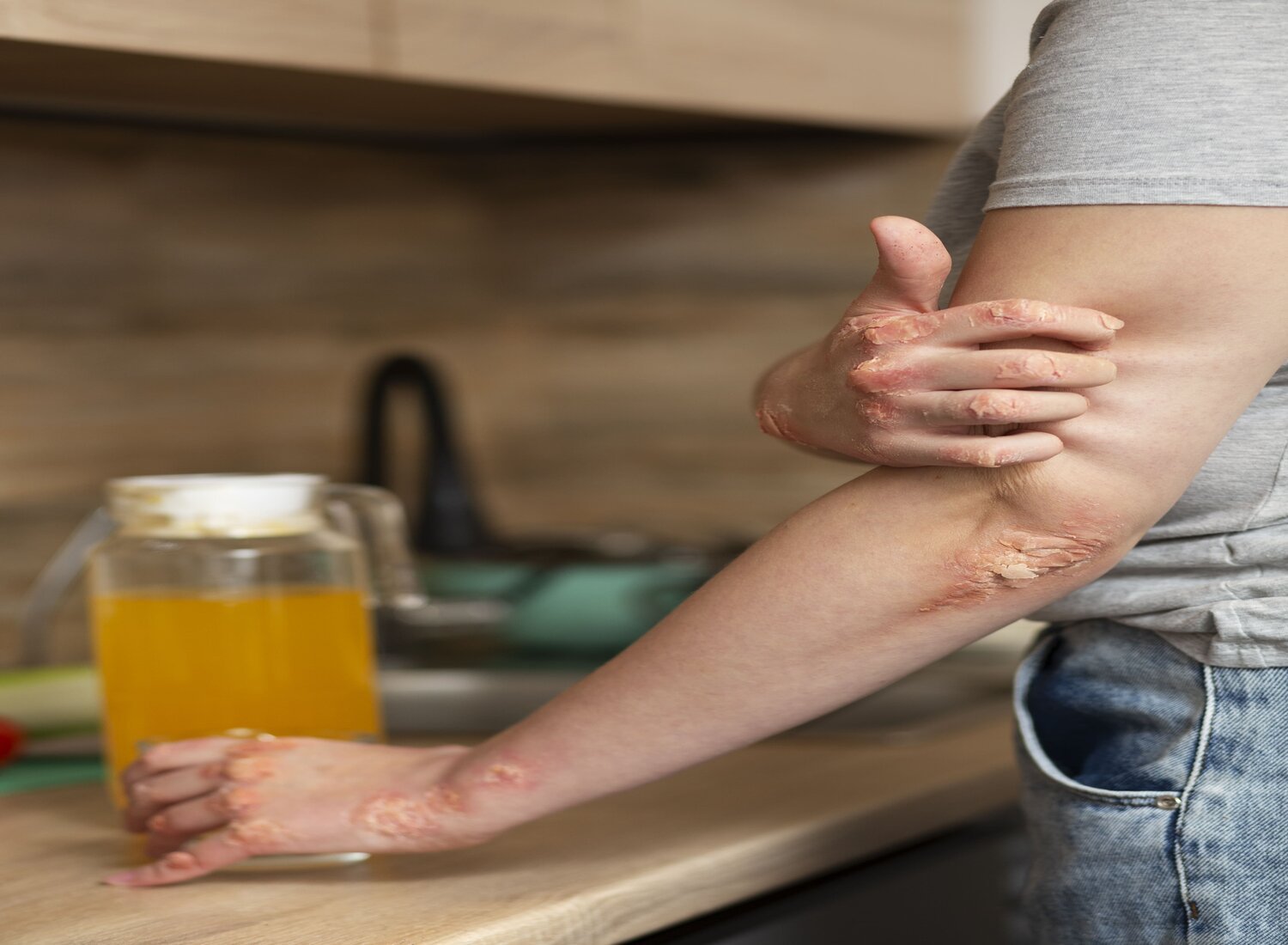 Plaque psoriasis shown on left elbow, wrist and hand appearing to scratch/itch area. scene in kitchen holding kitchen worktop with orange juice near hand. The most prevalent form, characterised by raised, red patches covered with silvery-white scales.