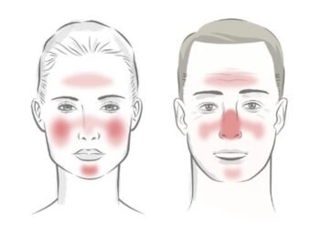 Rosacea male and female face showing rosacea on forehead cheeks chin nose