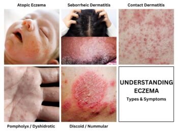 Understand Eczema Types And Symptoms images of skin condition contact dermatitis discoid nummular atopic pompholyx dyshidrotic