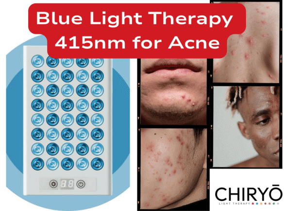 Blue Light Therapy 415nm for Acne