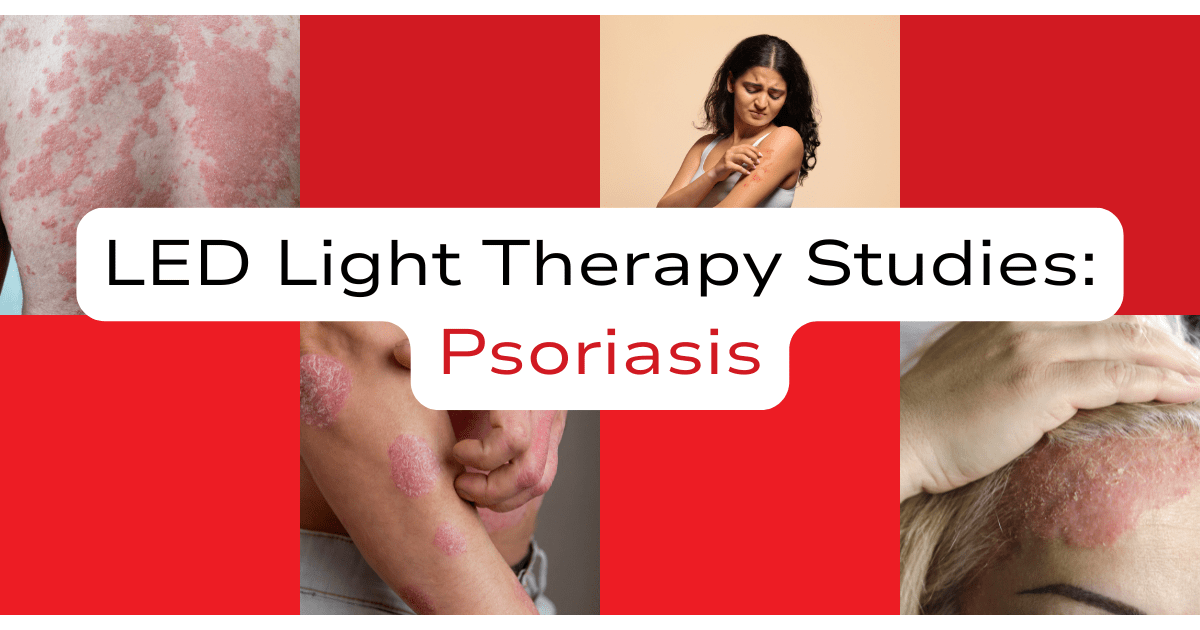 LED Light Therapy Studies Psoriasis Cure Found LED Light Therapy The Breakthrough Treatment You Need to Know LED-Light-Therapy-Studies-Psoriasis-Cure-Found-LED-Light-Therapy-The-Breakthrough-Treatment-You-Need-to-Know