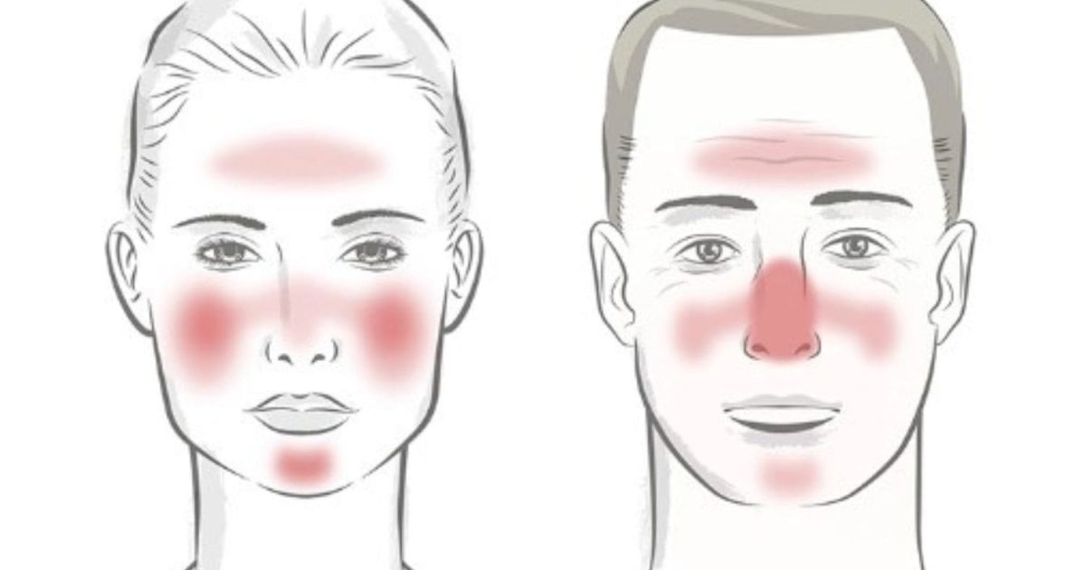 Rosacea male and female face showing rosacea on forehead cheeks chin nose